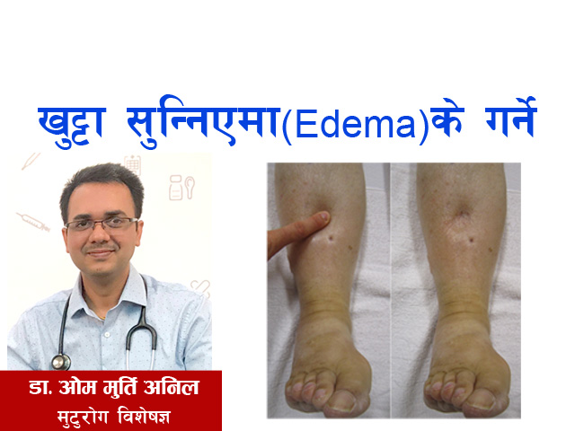 खुट्टा सुन्निएमा (Edema) के गर्ने ?